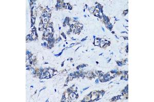 Immunohistochemistry of paraffin-embedded human breast cancer using HDAC5 antibody (ABIN6290464) at dilution of 1:100 (40x lens). (HDAC5 抗体)
