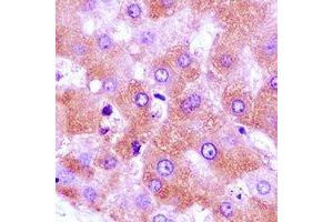 Immunohistochemical analysis of GNA11 staining in human liver cancer formalin fixed paraffin embedded tissue section. (GNA11 抗体)