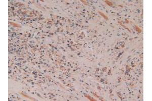 IHC-P analysis of Human Prostate Gland Cancer Tissue, with DAB staining. (Cytochrome C 抗体  (AA 5-100))