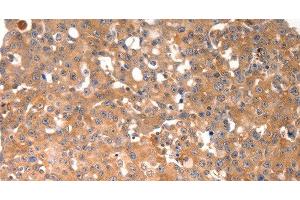 Immunohistochemistry of paraffin-embedded Human breast cancer tissue using BGLAP Polyclonal Antibody at dilution of 1:40 (Osteocalcin 抗体)