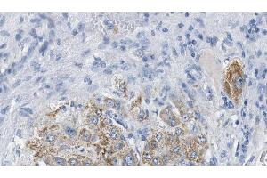 ABIN6274385 at 1/100 staining Human liver cancer tissue by IHC-P. (DOK7 抗体  (C-Term))