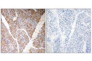 Immunohistochemistry analysis of paraffin-embedded human liver carcinoma tissue, using BAG3 antibody. (BAG3 抗体  (Internal Region))