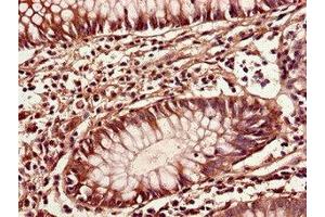 Immunohistochemistry of paraffin-embedded human colon cancer using ABIN7149396 at dilution of 1:100 (CIAO3 (AA 2-265) 抗体)