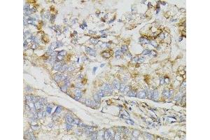 Immunohistochemistry of paraffin-embedded Human gastric cancer using NDUFS7 Polyclonal Antibody at dilution of 1:100 (40x lens). (NDUFS7 抗体)