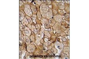 Formalin-fixed and paraffin-embedded human prostata carcinoma tissue reacted with CK1G (Center ) (ABIN391377 and ABIN2841388) , which was peroxidase-conjugated to the secondary antibody, followed by DAB staining. (CAMK1G 抗体  (AA 211-241))
