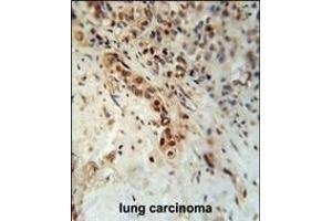 DCLRE1C Antibody (N-term) (ABIN653693 and ABIN2843013) immunohistochemistry analysis in formalin fixed and paraffin embedded human lung carcinoma followed by peroxidase conjugation of the secondary antibody and DAB staining. (DCLRE1C 抗体  (N-Term))