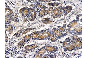 ABIN6257712 and ABIN6273523 at 1/100 staining human colorectal cancer by IHC-P. (IFRD1 抗体  (N-Term))