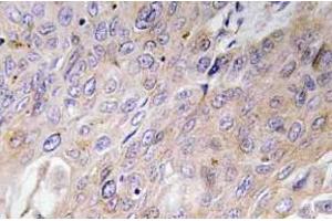 Immunohistochemistry (IHC) analyzes of BMP-3 antibody in paraffin-embedded human lung carcinoma tissue. (BMP3 抗体)