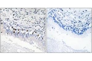 Immunohistochemistry analysis of paraffin-embedded human lung carcinoma, using MED12 Antibody. (MED12 抗体  (AA 611-660))