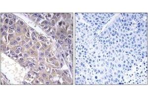 Immunohistochemistry analysis of paraffin-embedded human liver carcinoma tissue, using B4GALT3 Antibody. (B4GALT3 抗体  (AA 271-320))