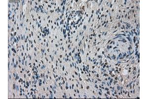 Immunohistochemical staining of paraffin-embedded Adenocarcinoma of breast tissue using anti-TMEM100 mouse monoclonal antibody. (TMEM100 抗体)