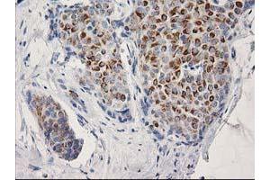 Immunohistochemical staining of paraffin-embedded Adenocarcinoma of Human breast tissue using anti-OSGEP mouse monoclonal antibody. (OSGEP 抗体  (AA 1-335))