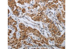 Immunohistochemistry of Human lung cancer using SPAG1 Polyclonal Antibody at dilution of 1:25 (SPAG1 抗体)