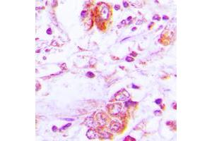 Immunohistochemical analysis of Follistatin staining in human lung cancer formalin fixed paraffin embedded tissue section. (Follistatin 抗体  (Center))