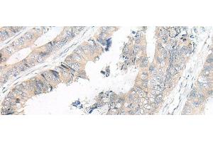 Immunohistochemistry of paraffin-embedded Human colorectal cancer tissue using FGF10 Polyclonal Antibody at dilution of 1:30(x200) (FGF10 抗体)