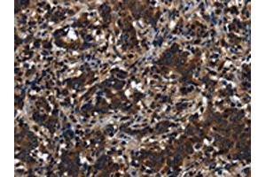 The image on the left is immunohistochemistry of paraffin-embedded Human liver cancer tissue using ABIN7191225(KLHL8 Antibody) at dilution 1/20, on the right is treated with synthetic peptide. (KLHL8 抗体)