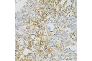 Immunohistochemistry of paraffin-embedded human prostate cancer using ND5 antibody (ABIN5975833) at dilution of 1/100 (40x lens). (MT-ND5 抗体)