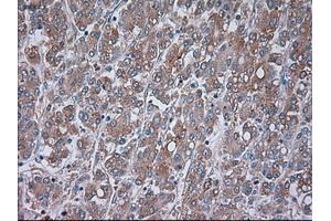 Immunohistochemical staining of paraffin-embedded Carcinoma of liver tissue using anti-TRPM4mouse monoclonal antibody. (TRPM4 抗体)