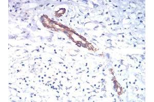 Immunohistochemical analysis of paraffin-embedded liver cancer tissues using TSHB mouse mAb with DAB staining. (TSHB 抗体  (AA 20-139))