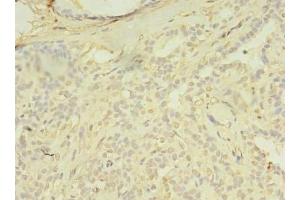 Immunohistochemistry of paraffin-embedded human breast cancer using ABIN7172654 at dilution of 1:100 (SPIC 抗体  (AA 1-248))
