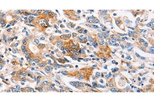 Immunohistochemistry of paraffin-embedded Human gasrtic cancer tissue using MC1R Polyclonal Antibody at dilution 1:100 (MC1 Receptor 抗体)