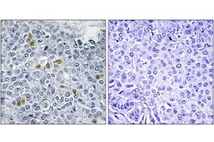 Immunohistochemical staining of paraffin-embedded human breast carcinoma tissue reacted with TOP2A (phospho S1106) polyclonal antibody  at 1:50-1:100 dilution.