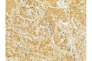 ABIN6265998 and ABIN6273087 at 1/100 staining Human breast cancer by IHC-P.
