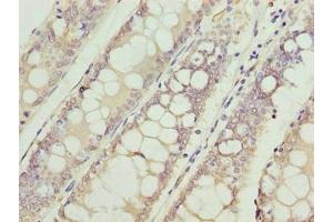 Immunohistochemistry of paraffin-embedded human colon cancer using ABIN7175315 at dilution of 1:100 (VPS45 抗体  (AA 101-400))