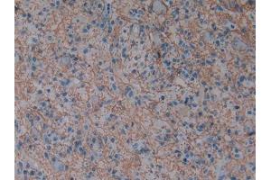 Detection of AQP1 in Human Glioma Tissue using Polyclonal Antibody to Aquaporin 1 (AQP1) (Aquaporin 1 抗体  (AA 201-269))