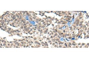 Immunohistochemistry of paraffin-embedded Human ovarian cancer tissue using REST Polyclonal Antibody at dilution of 1:50(x200) (REST 抗体)