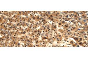 Immunohistochemistry of paraffin-embedded Human liver cancer tissue using TMOD1 Polyclonal Antibody at dilution of 1:60(x200) (Tropomodulin 1 抗体)