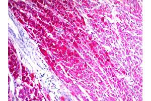 Formalin-fixed, paraffin-embedded human Melanoma stained with CD63 Mouse Monoclonal Antibody (NKI/C3) (AEC Chromogen) (CD63 抗体)