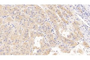 Detection of LH in Human Liver cancer Tissue using Polyclonal Antibody to Luteinizing Hormone (LH) (Luteinizing Hormone 抗体)