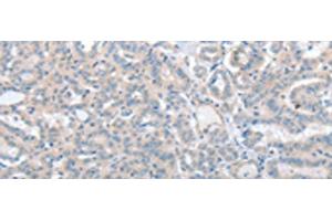 Immunohistochemistry of paraffin-embedded Human thyroid cancer tissue using SLC17A6 Polyclonal Antibody at dilution of 1:100(x200) (Solute Carrier Family 17 (Vesicular Glutamate Transporter), Member 6 (SLC17A6) 抗体)