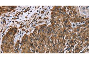 Immunohistochemistry of paraffin-embedded Human lung cancer tissue using PLXNB1 Polyclonal Antibody at dilution 1:40 (PLXNB1 抗体)