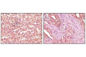 Immunohistochemical analysis of paraffin-embedded human skin carcinoma (left) and pancreas carcinoma (right) tissue, showing cytoplasmic localization using EphA2 antibody with DAB staining. (EPH Receptor A2 抗体)
