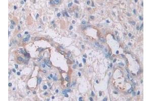 Detection of IL33 in Human Glioma Tissue using Monoclonal Antibody to Interleukin 33 (IL33) (IL-33 抗体  (AA 112-270))