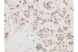 IHC-P Image Immunohistochemical analysis of paraffin-embedded OVCA xenograft, using NCBP1, antibody at 1:500 dilution. (NCBP1 抗体  (N-Term))