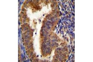 Immunohistochemistry analysis in formalin fixed and paraffin embedded human uterus tissue reacted with BNIP3L / BNIP3A Antibody (Center) followed which was followed by peroxidase conjugated to the secondary antibody and DAB staining. (BNIP3L/NIX 抗体  (Middle Region))