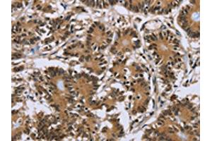 The image on the left is immunohistochemistry of paraffin-embedded Human colon cancer tissue using ABIN7191755(P2RY1 Antibody) at dilution 1/40, on the right is treated with synthetic peptide. (P2RY1 抗体)