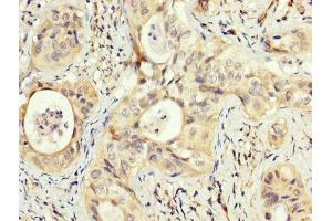 IHC image of ABIN7162986 diluted at 1:200 and staining in paraffin-embedded human cervical cancer performed on a Leica BondTM system. (PEX5 抗体  (AA 149-283))