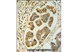 HCCS Antibody IHC analysis in formalin fixed and paraffin embedded colon carcinoma followed by peroxidase conjugation of the secondary antibody and DAB staining. (HCCS 抗体  (AA 173-200))
