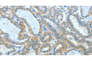 Immunohistochemistry of paraffin-embedded Human thyroid cancer using SPHK2 Polyclonal Antibody at dilution of 1:60 (SPHK2 抗体)