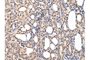 The image on the left is immunohistochemistry of paraffin-embedded Human thyroid cancer tissue using ABIN7127988(PPIL1 Antibody) at dilution 1/30, on the right is treated with fusion protein. (PPIL1 抗体)
