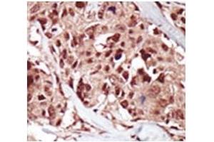 IHC analysis of FFPE human breast carcinoma tissue stained with the BRD4 antibody (BRD4 抗体  (AA 1-30))