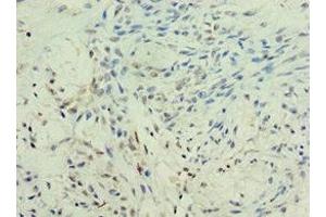 Immunohistochemistry of paraffin-embedded human breast cancer using ABIN7157755 at dilution of 1:100 (KMO 抗体  (AA 1-260))