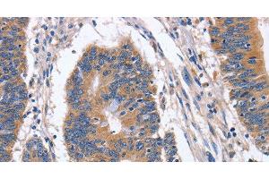 Immunohistochemistry of paraffin-embedded Human colon cancer tissue using BMP6 Polyclonal Antibody at dilution 1:40 (BMP6 抗体)