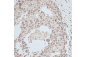 Immunohistochemistry of paraffin-embedded human breast cancer using ZNF703 antibody (ABIN7271524) at dilution of 1:100 (40x lens). (ZNF703 抗体  (AA 160-290))