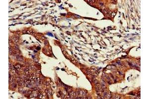 Immunohistochemistry of paraffin-embedded human colon cancer using ABIN7176539 at dilution of 1:100 (Zinc Finger Protein 816A (ZNF816A) (AA 1-200) 抗体)