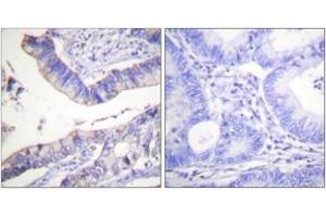 Immunohistochemistry analysis of paraffin-embedded human colon carcinoma tissue, using BCL-2 (Ab-69) Antibody. (Bcl-2 抗体  (AA 46-95))